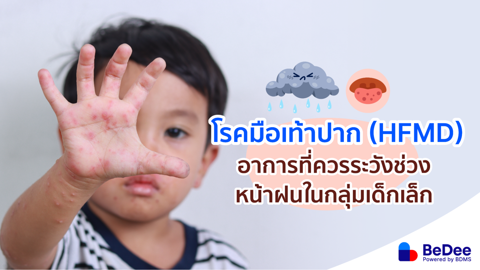 โรคมือเท้าปาก